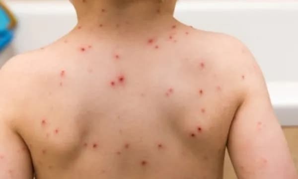 IKShPK: 147 raste të fruthit në Kosovë, 10 të reja vetëm gjatë javës së fundit