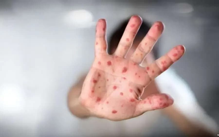 IKShPK: 158 raste me fruth, mbi 95% të pavaksinuar