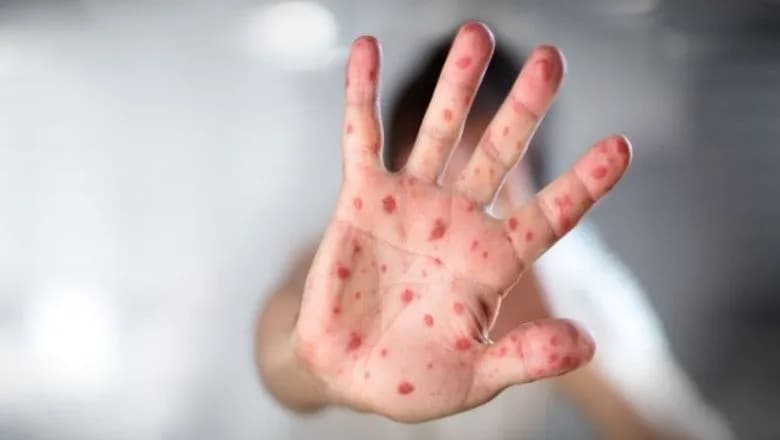 IKShPK: 36 raste me fruth të konfirmuara në Kosovë brenda dy muajve
